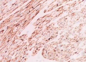 SMA Dương tính mạnh bào tương DESMIN Dương tính bào tương CALDESMON Dương tính 12