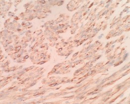 CALDESMON Dương tính với bào tương DOG 1 Âm tính với tế bào u DANH SÁCH BỆNH 13