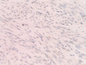 CALDESMON Dương tính với bào tương DOG 1 Âm tính với tế bào u DANH SÁCH BỆNH 14