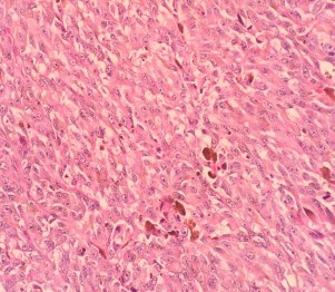 HE x 100 Tế bào u hình thoi nhân lớn rõ hạt nhân HE x 400 U giàu nhân chia bài 2