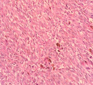 HE x 400 U giàu nhân chia bài tương giàu hạt sắc tố CHE x 400 U xâm nhập mạch 3