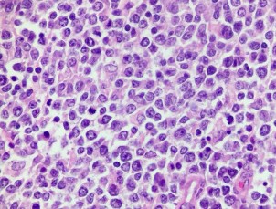 HE x 100 Tế bào u nhân lớn bào tương hẹp rời rạc HE x 400 Tế bào u nhân 5