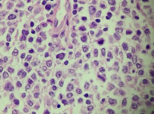 HE x 100 Tế bào u nhân lớn bào tương hẹp rời rạc HE x 400 Tế bào u nhân 6