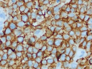 CD20 Dương tính mạnh với màng bào tương MUM1 Dương tính với nhân Bệnh nhân 7