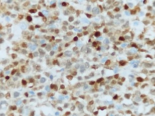 CD20 Dương tính mạnh với màng bào tương MUM1 Dương tính với nhân Bệnh nhân 8