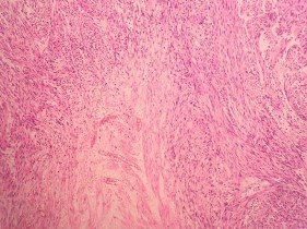 HE x 100 Các tế bào u hình thoi nhân bàu bào tương hồng sắp xếp thành bó HE x 9