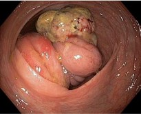 B Hình 1 6 Hình ảnh đại thể u ở hồi manh tràng A 33 và dạ dày B 24 5