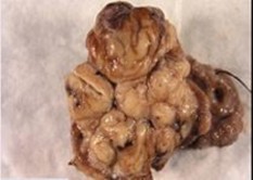 Hình 1 6 Hình ảnh đại thể u ở hồi manh tràng A 33 và dạ dày B 24 Thông 6