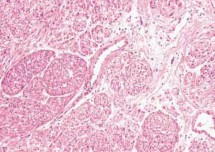 Hình 1 7 Hình ảnh vi thể 24 Độ ác tính thấp cao và trung bình của u cơ 7