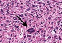 Hình 1 7 Hình ảnh vi thể 24 Độ ác tính thấp cao và trung bình của u cơ 8