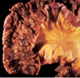 Hình 1 9 Tổn thương dạng đa polyp loét gây hẹp ở ruột non 62 U lympho MALT 1