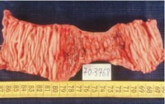 Hình 1 9 Tổn thương dạng đa polyp loét gây hẹp ở ruột non 62 U lympho MALT 2