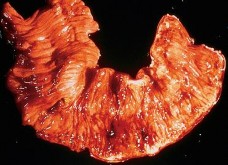 Hình 1 10 Tổn thương Tế bào T dạng nhiều loét nhỏ và dạng loét vòng chu vi 3