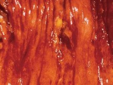 Hình 1 10 Tổn thương Tế bào T dạng nhiều loét nhỏ và dạng loét vòng chu vi 4