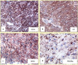 Hình 1 12 HMMD với CD34 a KIT b DOG1 c PDGFR d 75 và Hình ảnh cơ chế sinh học 1