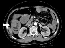 Hình 1 13 U thần kinh ác tính ở hồi tràng gây lồng ruột 83 U có thể có gây 3