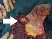 Hình 1 13 U thần kinh ác tính ở hồi tràng gây lồng ruột 83 U có thể có gây 4