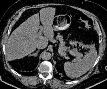 Hình 1 14 U mỡ ác tính tại dạ dày 86 Ruột non Tác giả Mohammad Amx Mỹ là 5