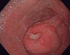 Hình 1 14 U mỡ ác tính tại dạ dày 86 Ruột non Tác giả Mohammad Amx Mỹ là 6