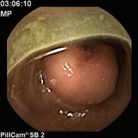 Hình 1 15 U mỡ ác tính ruột non ảnh chụp từ viên camera nội soi 98 Đại 7