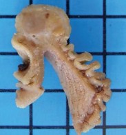 Hình 1 15 U mỡ ác tính ruột non ảnh chụp từ viên camera nội soi 98 Đại 8