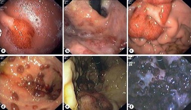 Hình 1 16 KS tại dạ dày ban sần a b nốt hay polyp c d e f 105 Trên lâm sàng 9