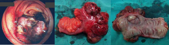 Hình 1 17 Tổn thương u ở đại tràng 108 110 Theo nhóm tác giả khác Lahat và 1