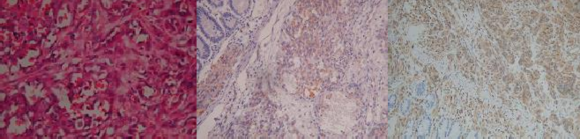 Hình 1 18 Hình ảnh vi thể và HMMD với CD31 và Vimentin 111 Vi thể dễ chẩn 2