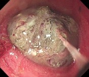 A B C Hình 1 19 Hình ảnh đại thể của u hắc tố ác tính nguyên phát tại Ruột 3