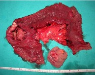 B C Hình 1 19 Hình ảnh đại thể của u hắc tố ác tính nguyên phát tại Ruột 4