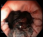 C Hình 1 19 Hình ảnh đại thể của u hắc tố ác tính nguyên phát tại Ruột non 5