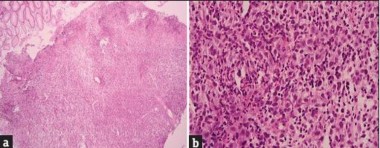 Hình 1 20 Hình ảnh vi thể với nhuộm HEx10 a và HEx40 B HMMD Dương tính mạnh 6