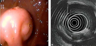 Hình 1 21 Hình ảnh đại thể và siêu âm nội soi khối u ở môn vị 134 Ruột 7