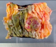 Hình 1 22 U cuộn mạch dưới niêm mạc tại hỗng tràng 135 Ngoài ra cũng có 8