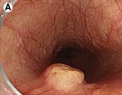 Hình 1 23 Hình ảnh đại thể u ở thực quản 145 146 Vi thể gồm các tế bào 1