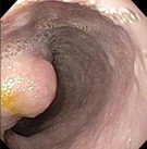 Hình 1 23 Hình ảnh đại thể u ở thực quản 145 146 Vi thể gồm các tế bào 2