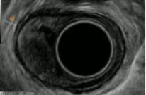 Hình 1 23 Hình ảnh đại thể u ở thực quản 145 146 Vi thể gồm các tế bào 3