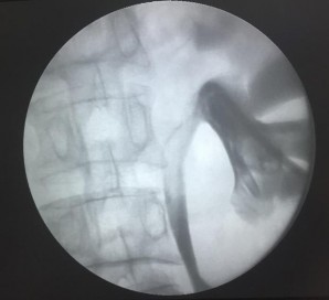 Hình 2 23 Kiểm tra vị trí ống dẫn lưu Pigtail 8F Nguồn chụp tại Bệnh Viện 1