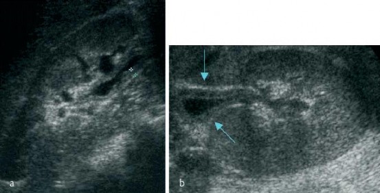 Hình 1 3 Hình ảnh dày thành bể thận mũi tên trong VTBT Nguồn Mitterberger M và 1