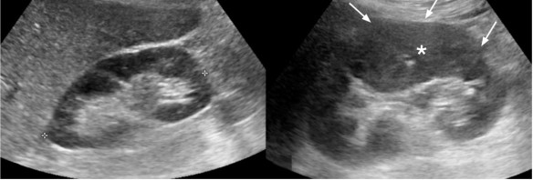 Hình 1 5 Bệnh nhân nữ 42 tuổi đau vùng thắt lưng bên trái và sốt Siêu âm có 2