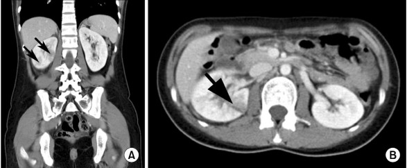 Hình 1 6 Hình ảnh VTBT cấp tính trên phim chụp cắt lớp vi tính ở thì nhu mô sau 3