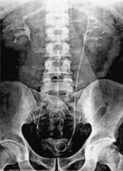 Hình 1 9 Đầu trên thông JJ ở trong đài thận trên Nguồn El Nahas A R 2006 51 3