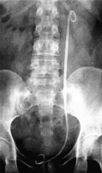 Hình 1 9 Đầu trên thông JJ ở trong đài thận trên Nguồn El Nahas A R 2006 51 4