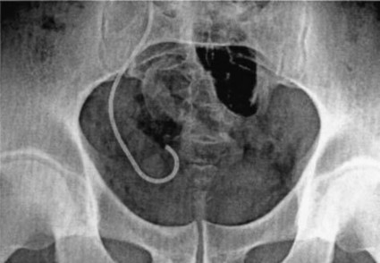 Hình 1 11 Đầu dưới ống thông JJ không cuộn tròn hết Nguồn El Nahas A R 2006 5