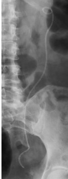 Hình 1 12 Ống thông JJ di chuyển về đầu gần niệu quản phía thận Nguồn Dyer 6