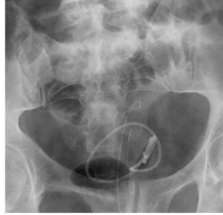 Hình 1 12 Ống thông JJ di chuyển về đầu gần niệu quản phía thận Nguồn Dyer 7