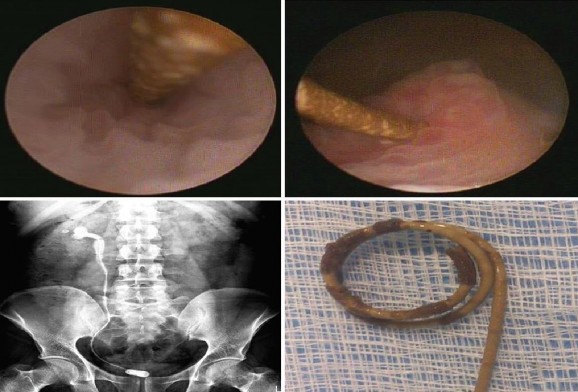 Hình 1 14 Ống thông niệu quản JJ vôi hóa trên phim hệ tiết niệu không chuẩn 8