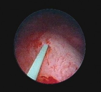 Hình 2 8 Đặt dây dẫn đường vào niệu quản Nguồn chụp tại Bệnh Viện 1