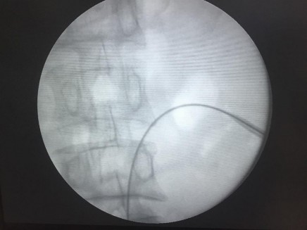 Hình 2 21 Nong tạo đường hầm dưới kiểm soát của màn hình tăng sáng Nguồn 10