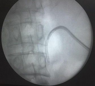 Hình 2 22 Đặt ống dẫn lưu Pigtail 8F vào hệ thống đài bể thận Nguồn chụp 11